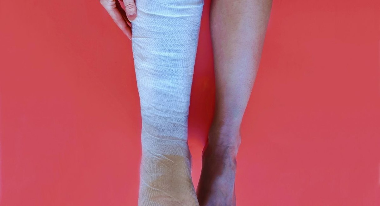 Jambe dans un platre blanc a cote de la jambe valide